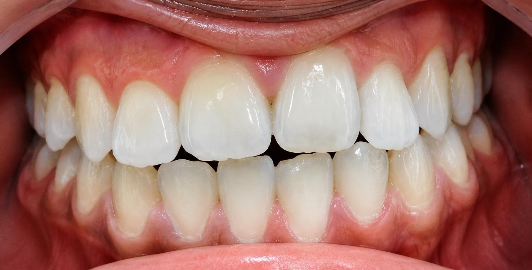 Aligners, before photo