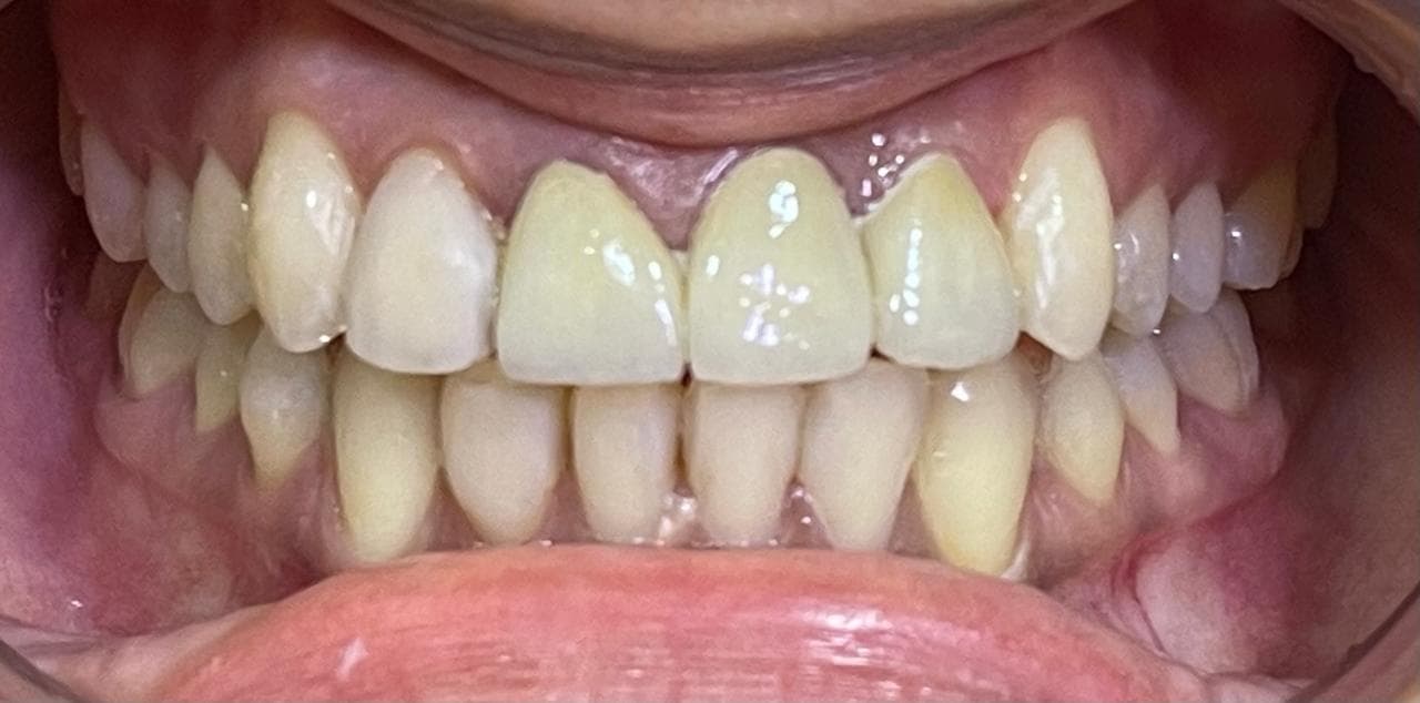 Crowns and Bridges, after photo