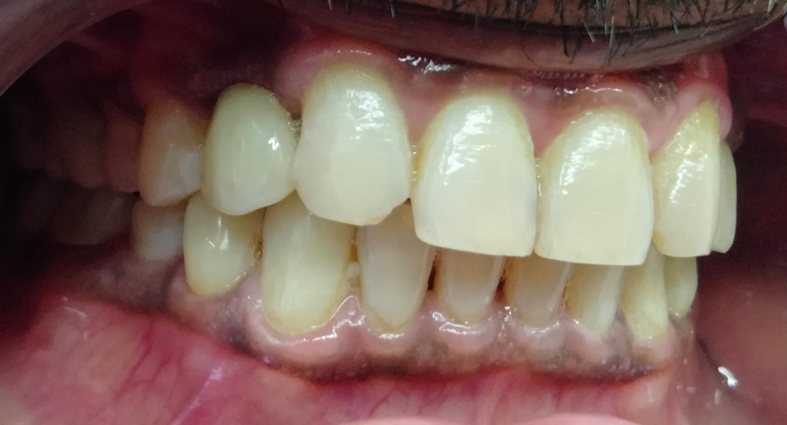 Dental Implant, after photo