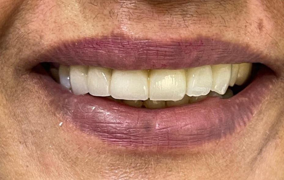 Full Mouth Rehabilitation, after photo