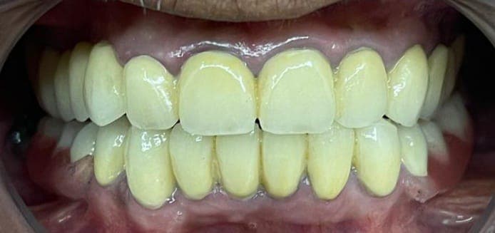 Full Mouth Rehabilitation, after photo