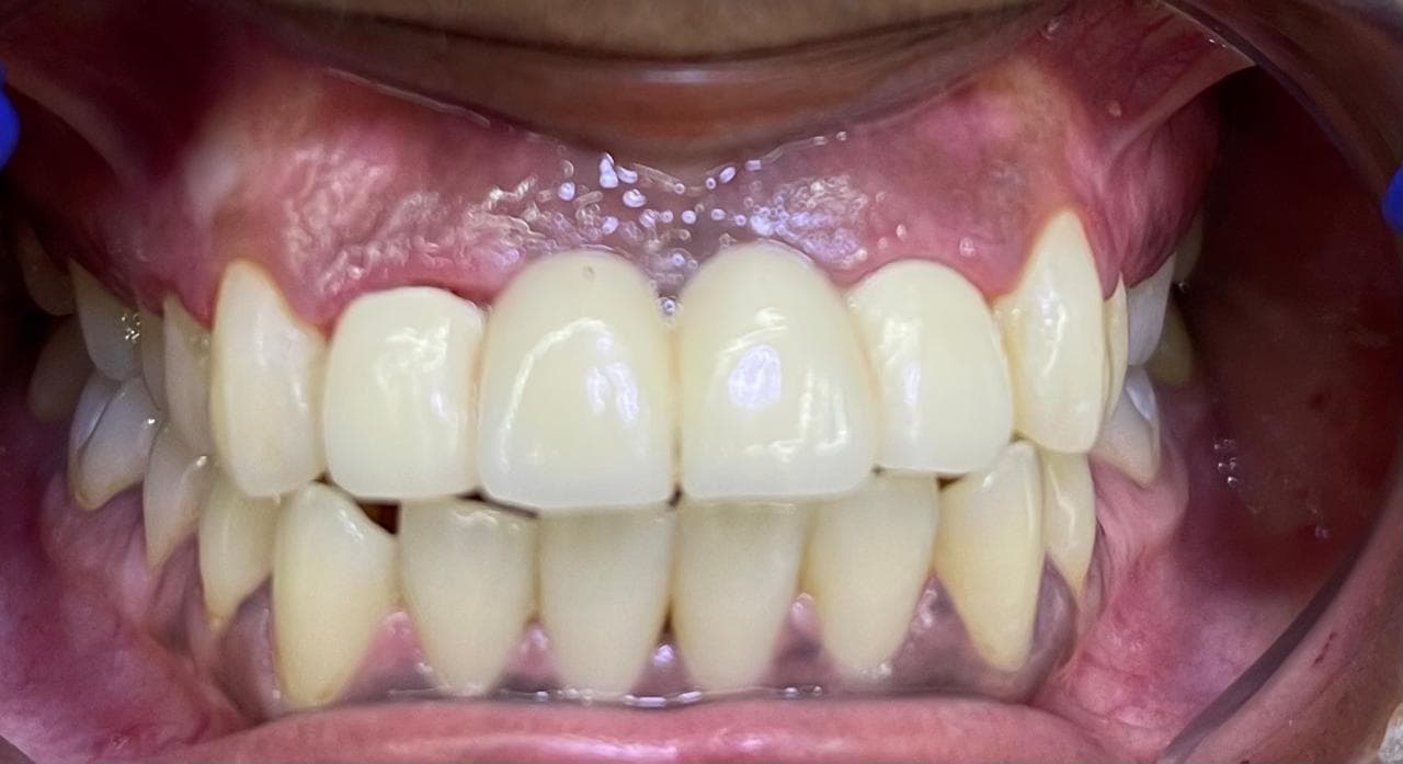 Laser Depigmentation and Gingivectomy, after photo