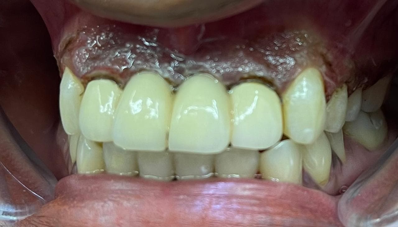 Laser Depigmentation and Gingivectomy, before photo