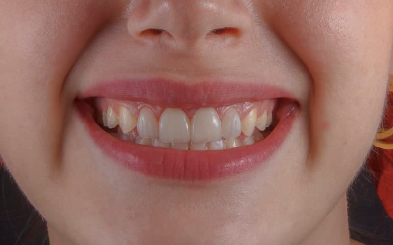 Why Do Teeth Become Sensitive? Chennai Dentist Explains