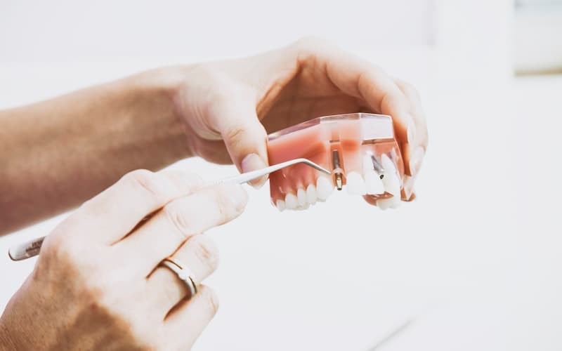 Dental Implants vs Dentures vs Bridges, Which is Best for You?