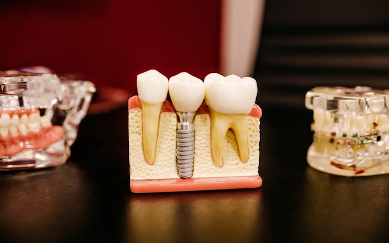 How Much Do Dental Implants Cost in Chennai? (2026 Complete Guide)