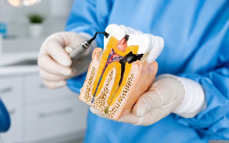 Single-Sitting Root Canal vs Multi-Visit, What Chennai Patients Should Know