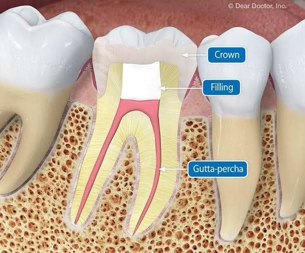 Root Canal Treatment